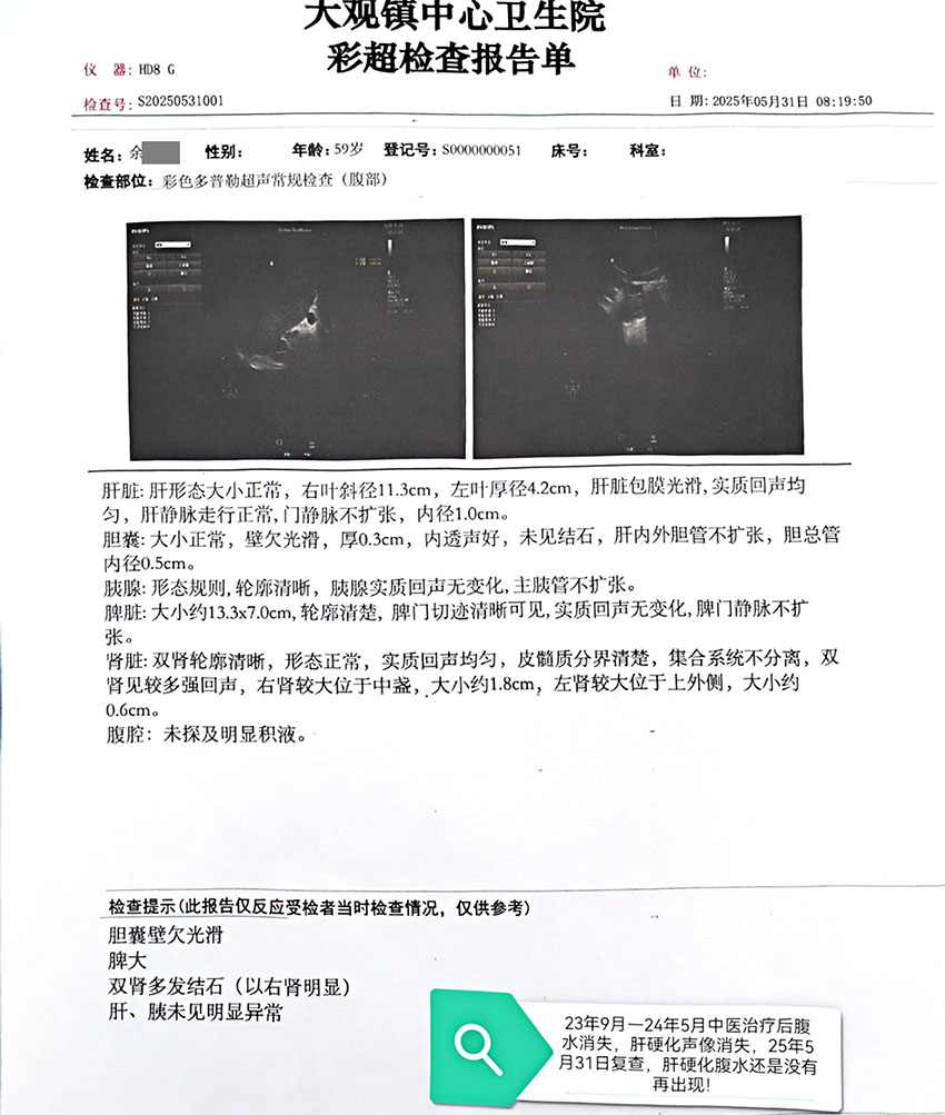 中医治疗之肝硬化腹水（腹部）