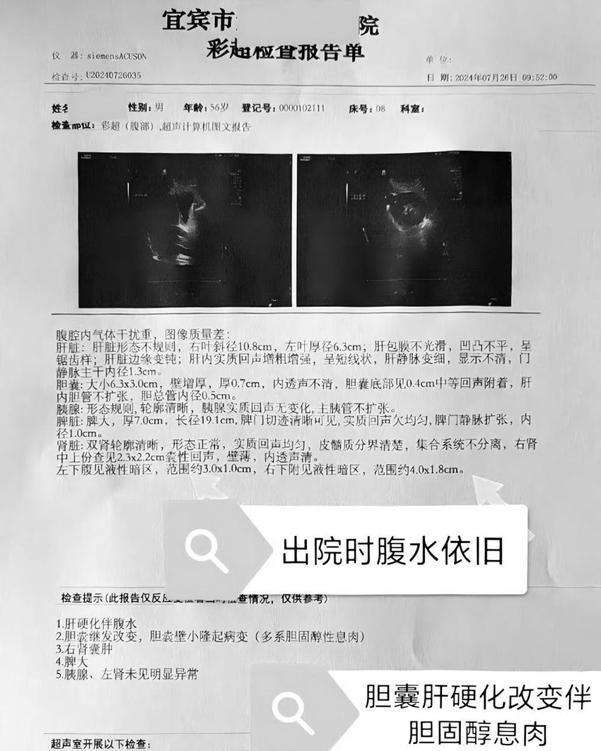 中医治疗之肝硬化腹水（手掌）